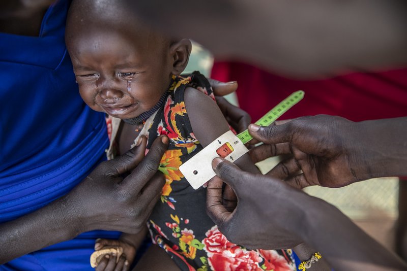Unterernährtes Kind im Südsudan