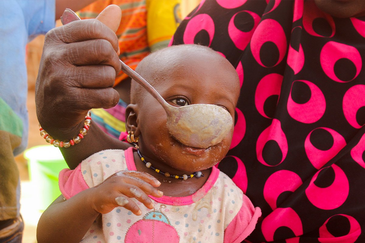 Ein Kleinkind wird mit spezieller Nahrung gefüttert.